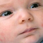 Por qué le salen granitos en la cara a los recién nacidos
